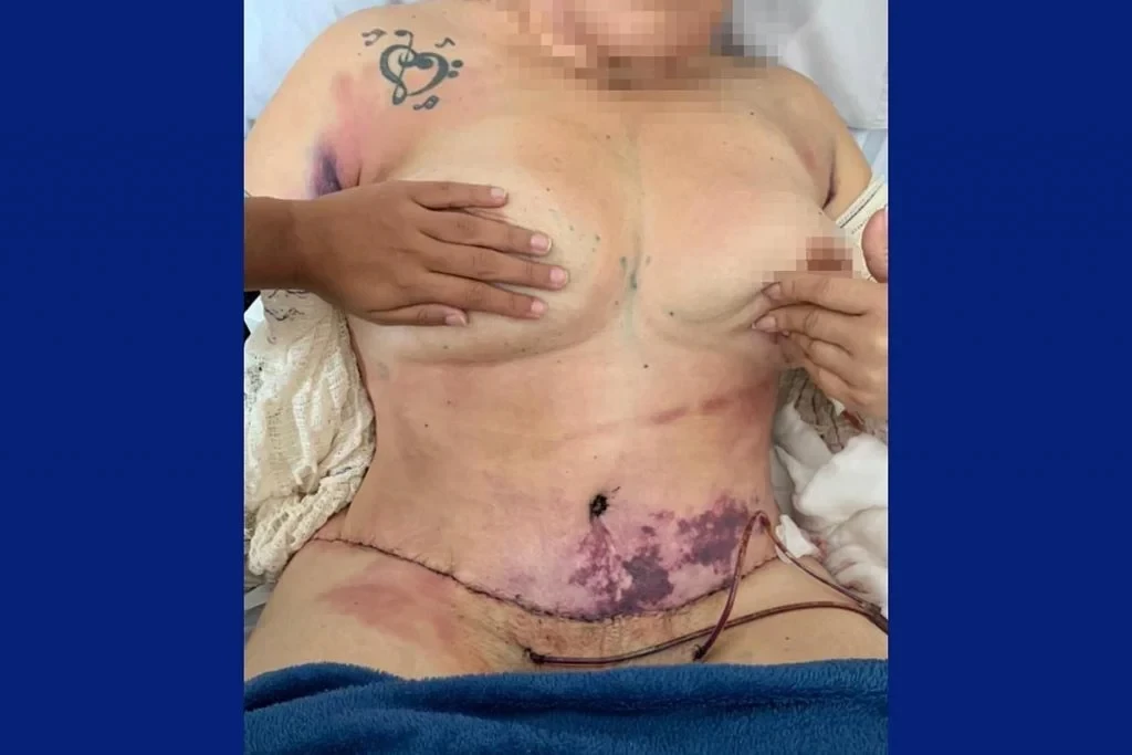 Uma das pacientes, após a retirada de pele e gordura da barriga, sofreu infecção por duas bactérias - Foto: Reprodução/Material Cedido ao Metrópoles