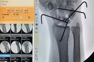 Primeira ligamentoplastia com âncora realizada pelo HEF - FOTO: Divulgação